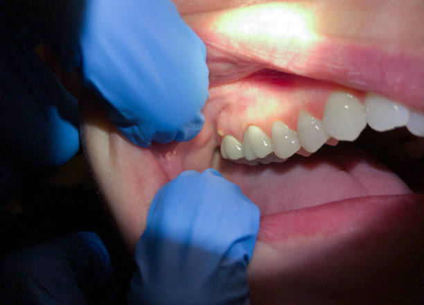 Best Emergency Treatment for Dental Infections or Abscesses in Sedro Woolley, WA